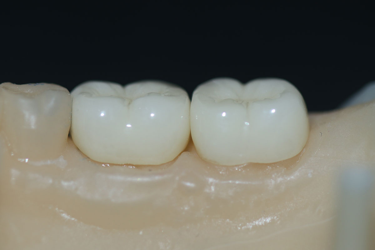 Digital Monolithic Zirconium: Combining Durability and Naturalness in Smile Aesthetics