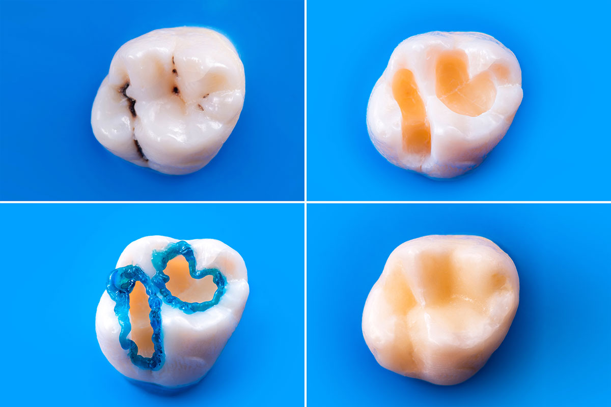 Composite Filling: Aesthetic and Robust Solution