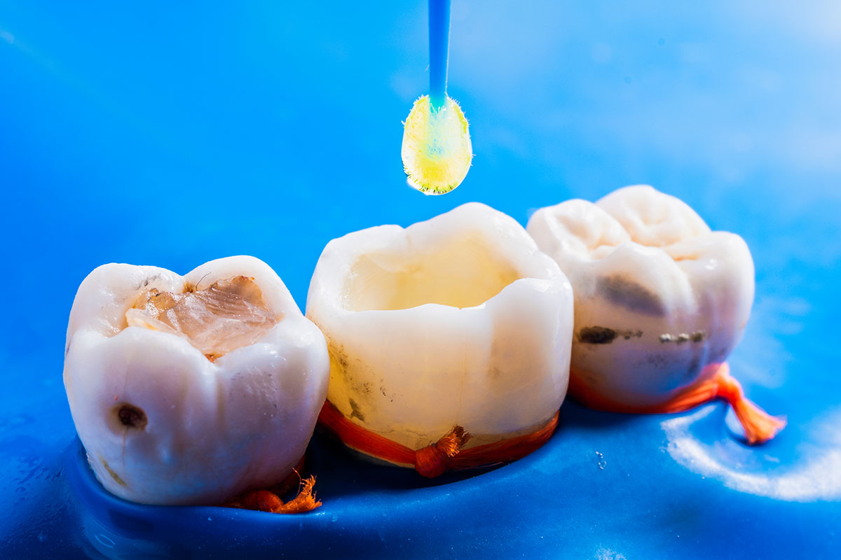 Dental Bonding Nedir?